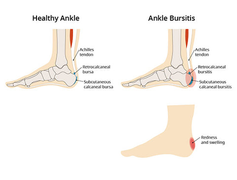 tendon above heel hurts