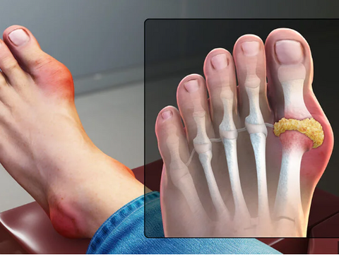 gout feet,swelling,feet pain