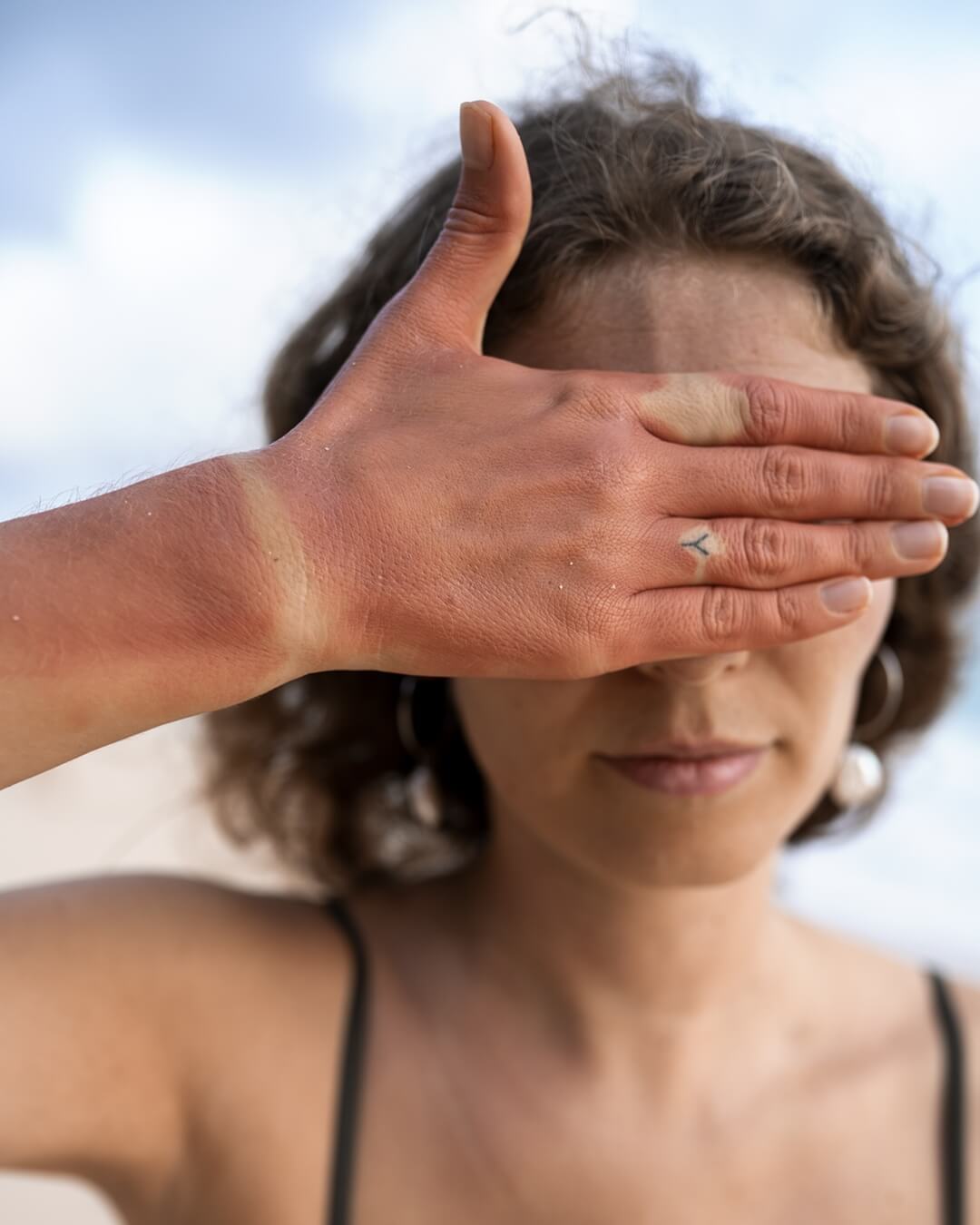 close-up of woman's sunburn skin from beach sun, a reminder to wear sustainable hats