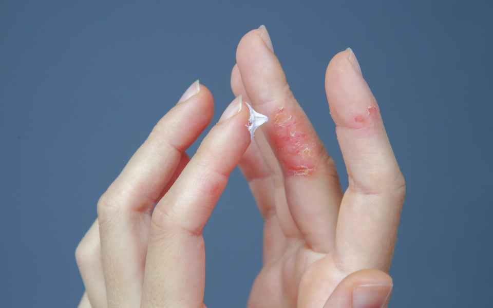 person with dermatitis applying tallow salve to skin