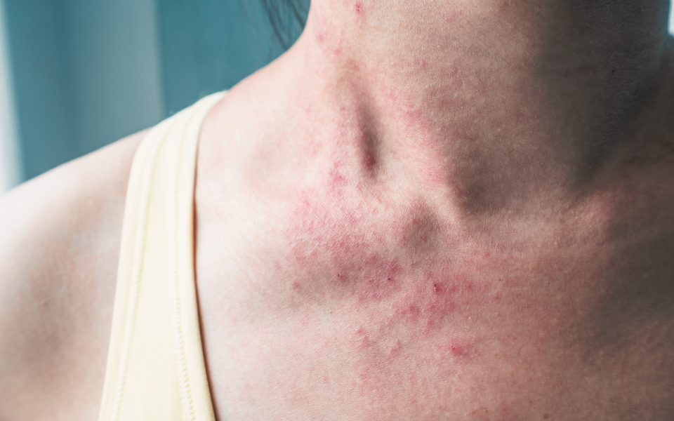 skin rash on neck of woman