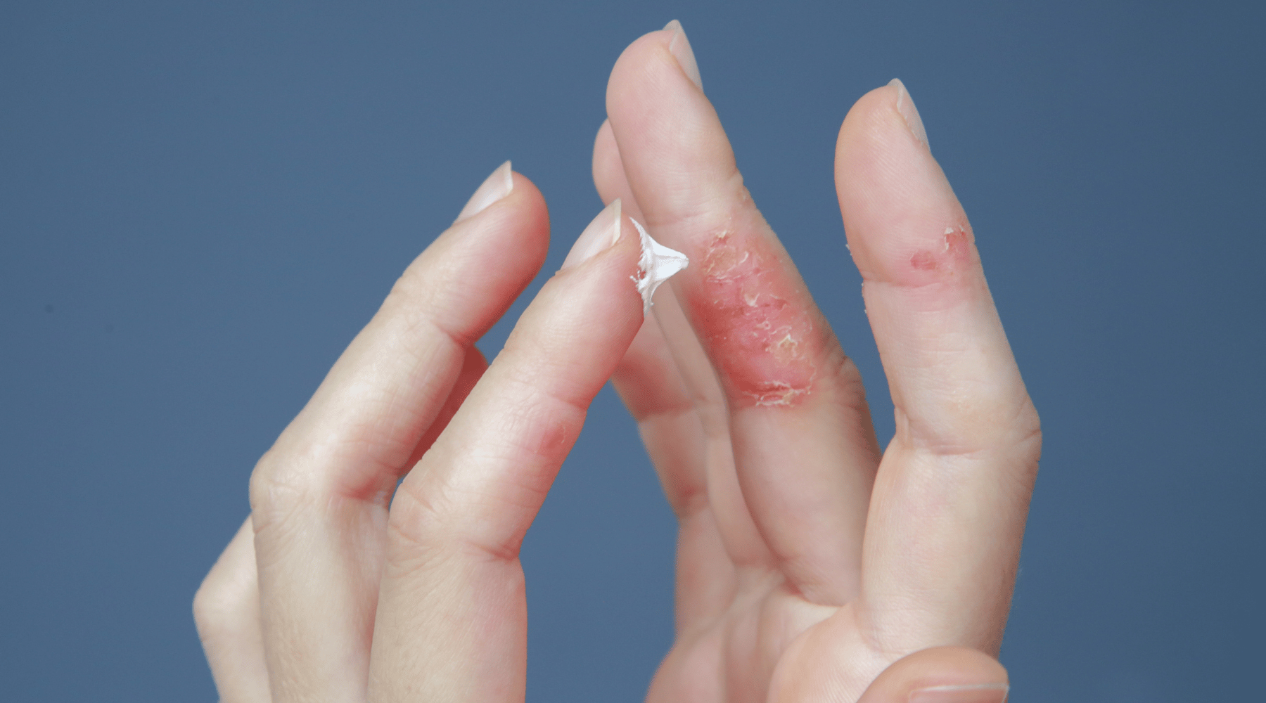 finger with eczema with tallow cream applying