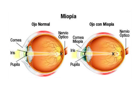 Aqui se muestra como es el ojo de un miopia de una persona con miopia más alargado de lo común