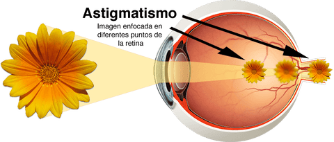 Causa del astigmatismo porqué se provoca y donde se forma la imagen en el ojo de una persona con astigmatismo