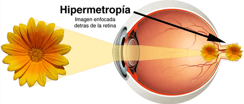 Presbicie Presbicia o Hipermetropia Que es y porque se produce donde se forma la imagen en el ojo