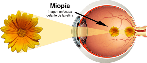 Esta imagen muestra donde se forma la imagen y como ve una persona miope sin lentes para la miopia