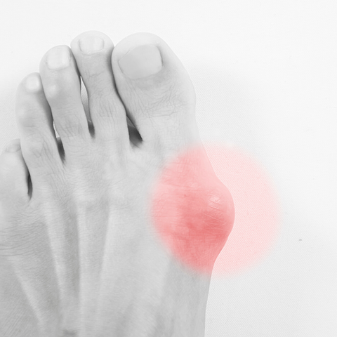 Bunions and yoga and your alignment?