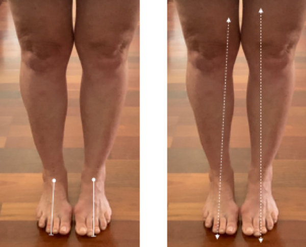 Bunions and yoga and your alignment?