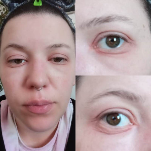 Allergic reaction to lash extensions - Personal Account from PLA, Recovered
