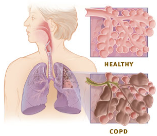 COPD