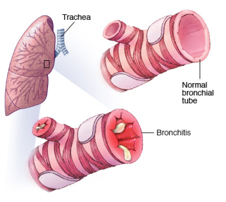 bronchitis and oxygen needs