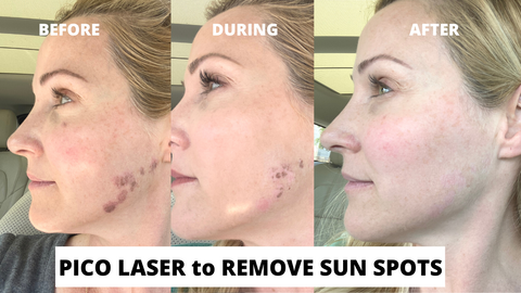 Pico Laser SunLux Skincare