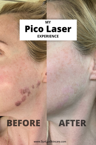 Pico Laser Treatment 