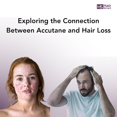 Connection Between Accutane and Hair Loss