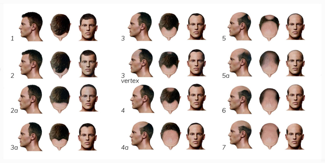 Hair Loss In Men Myhairsmart