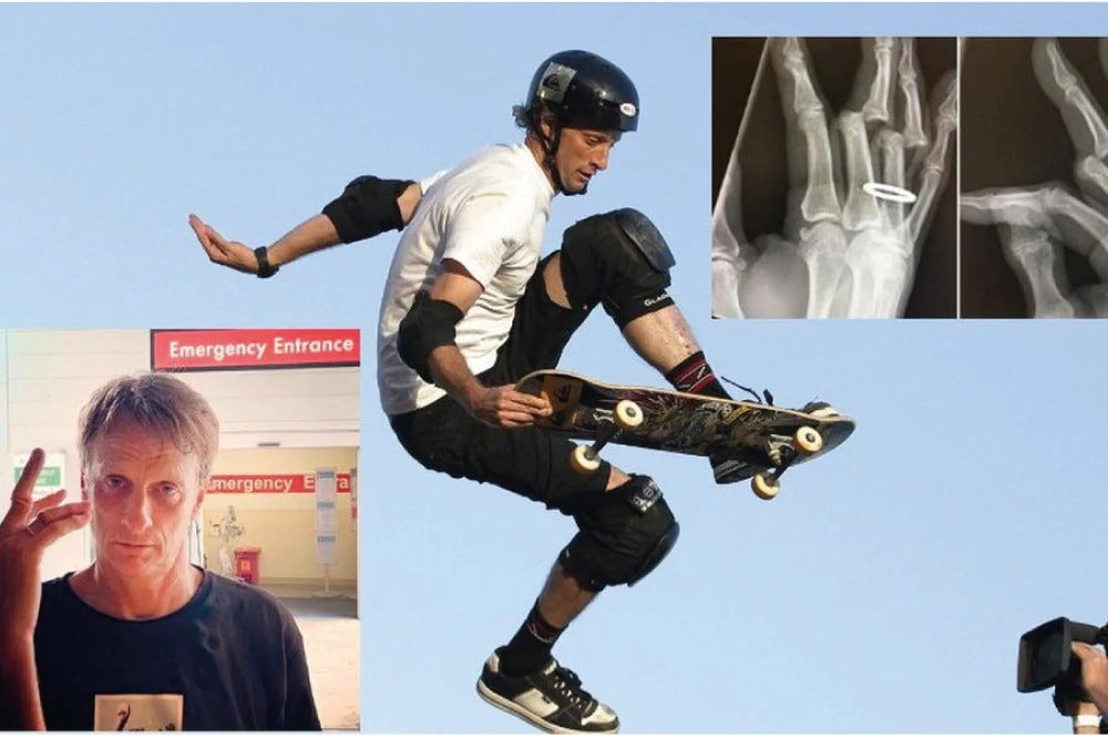 The worst injury Tony Hawk suffered in his career