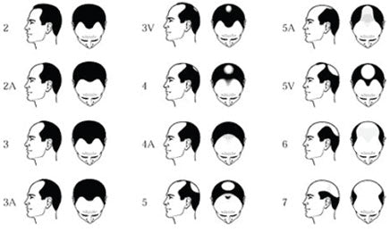 7 Stages of Male Pattern Baldness Male Balding Patterns 101