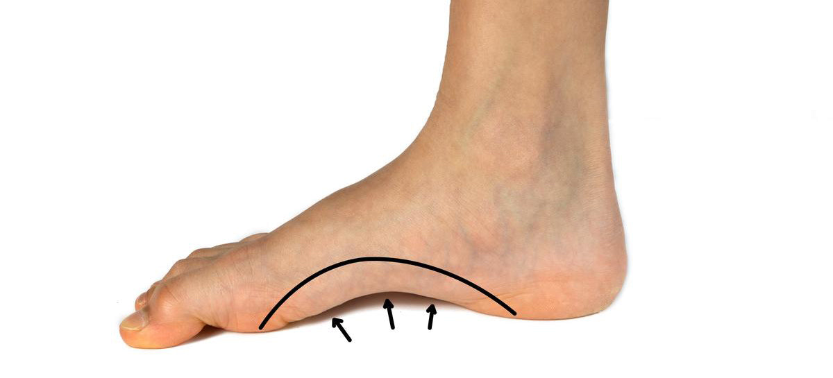 Douleurs pieds creux : complications et traitements | Smartfeet