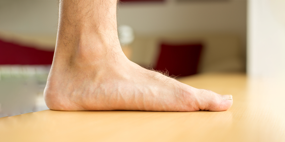 Avanceret tilstand af flad fod