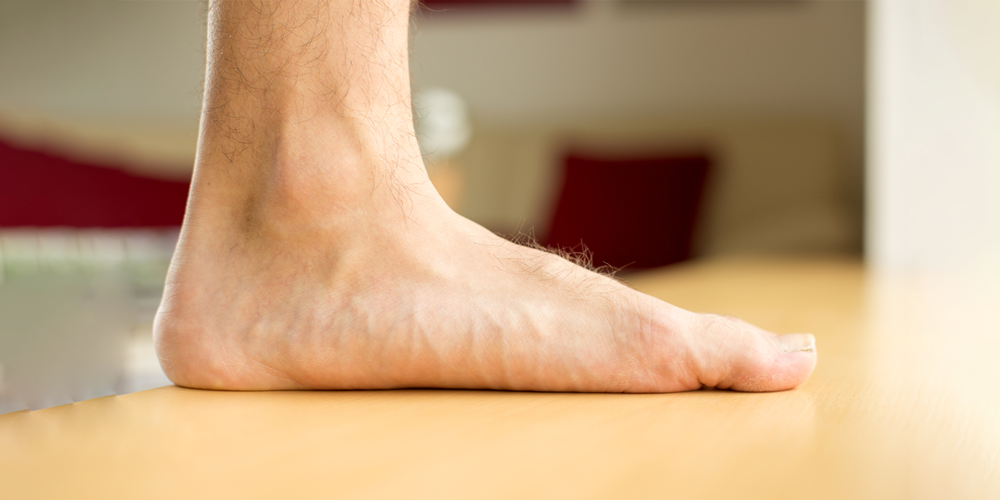 Advanced pathological condition of flat foot