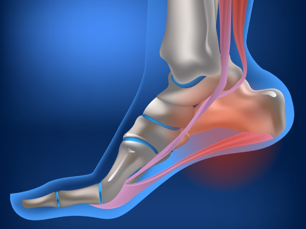 plantar fasciitis fasciosis inflammatory degenerative changes