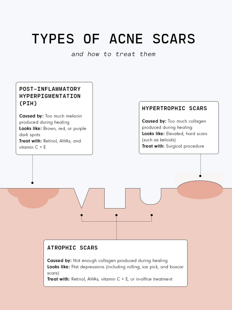 Types of Acne Scars