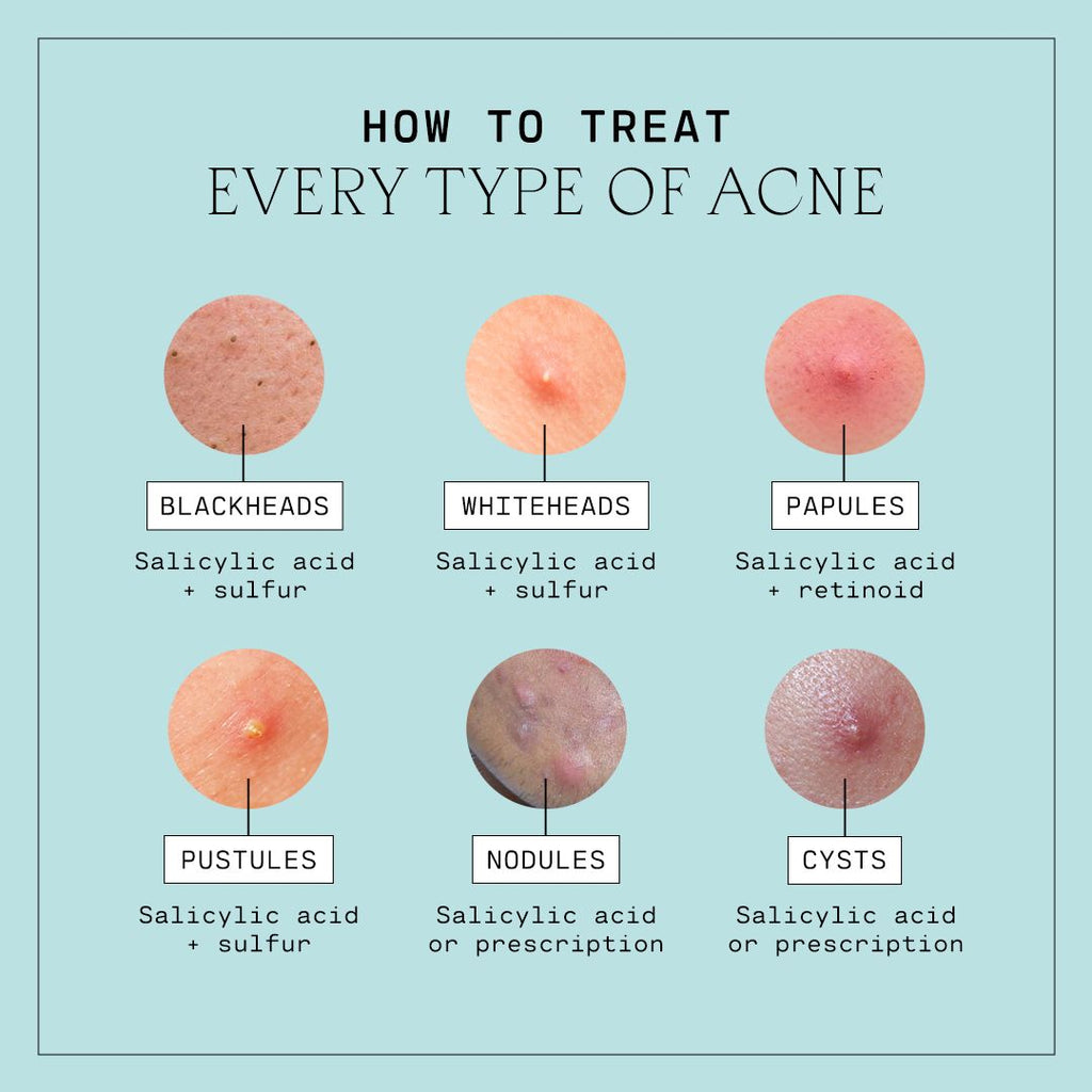 Types of Acne, Explained – Versed Skin