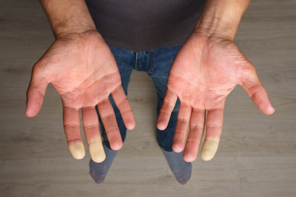 20 DMSO Uses you Might Not Know About close up man with hands up showing raynauds in fingertips
