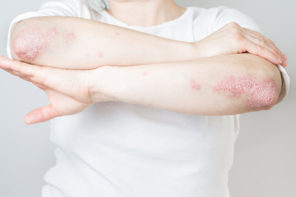 what is psoriatic arthritis causes symptoms of psoriatic arthritis and natural remedies for psoriatic arthritis woman with psoriasis on elbows and forearms wearing white shirt against white background