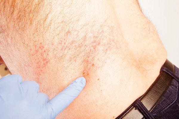 what is the shingles virus shingles causes man with shingles rash on left side gloved hand pointing