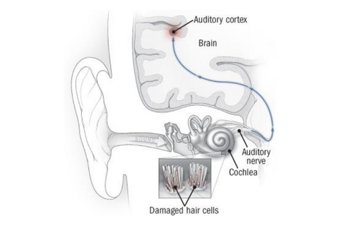 Diagram of damaged hair cells causing hearing loss