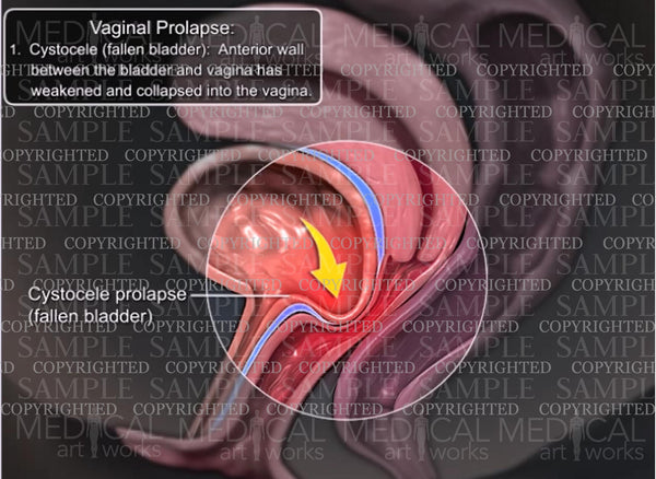 Prolapse Art