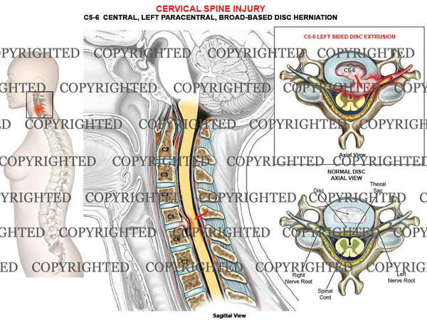 C5 6 Left Paracentral Disc Herniation Extrusion — Medical Art Works