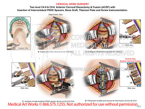 C3-4 and C4-5 discectomy