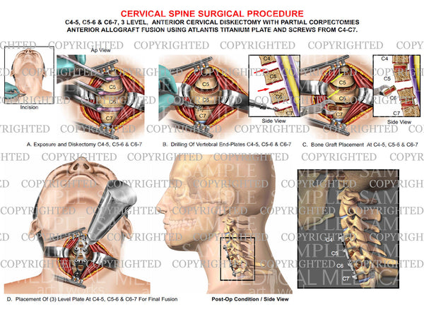 C4-5, C5-6 & C6-7 cervical discectomy + fusion — Medical Art