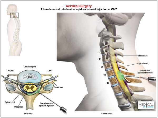 C6 7 Cervical Interlaminar Epidural Steroid Injection Male — Medical Art Works 5834