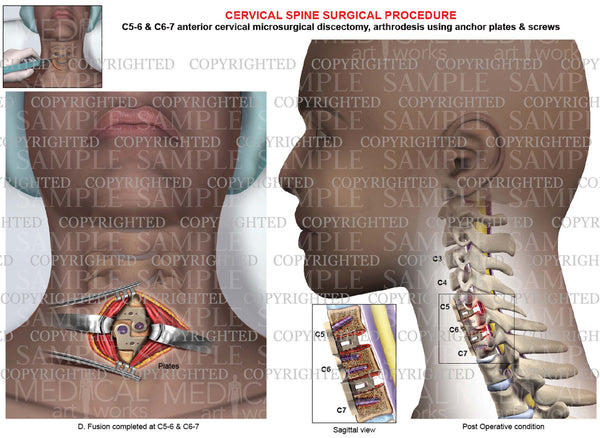 C5 6 C6 7 Post Operative Condition Anterior Cervical Discectomy And Fusion Plate And Screws 