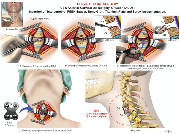1 Level C5 6 Anterior Cervical Discectomy And Fusion Acdf — Medical