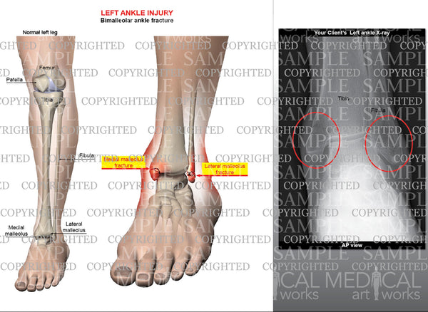 left lateral malleolus fracture