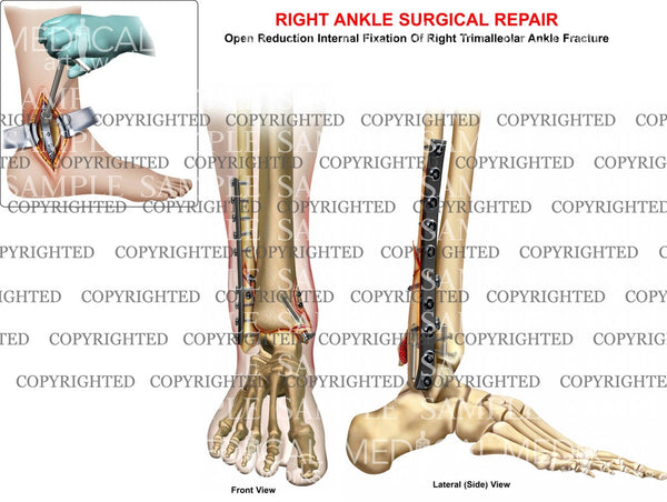 trimal ankle fracture