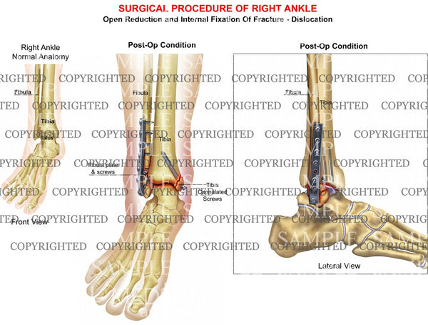 tib fib fracture and arthritis