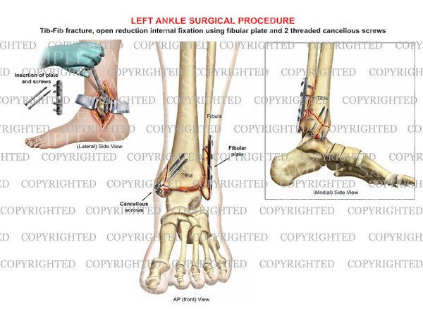 bimalleolar fracture orthobullets
