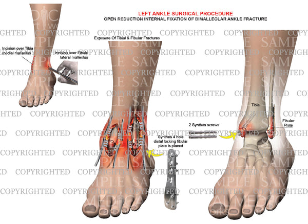 bimalleolar ankle fracture surgery