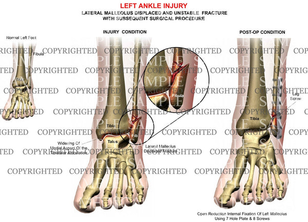 right ankle lateral malleolus fracture icd 10