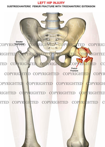 Subtrochanteric Femoral Fracture