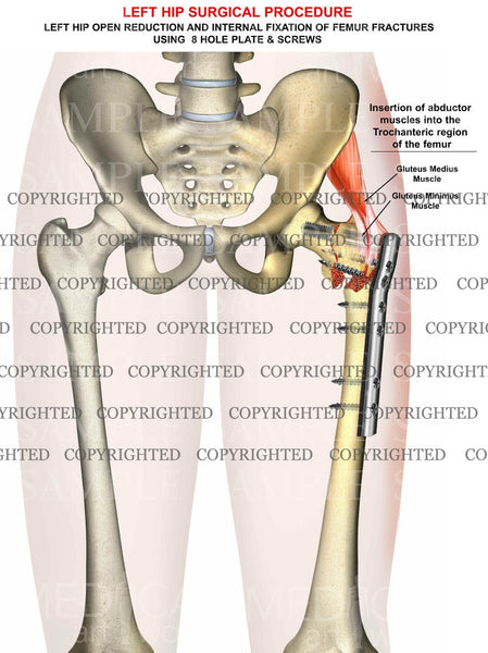 icd 10 code for left intertrochanteric fracture