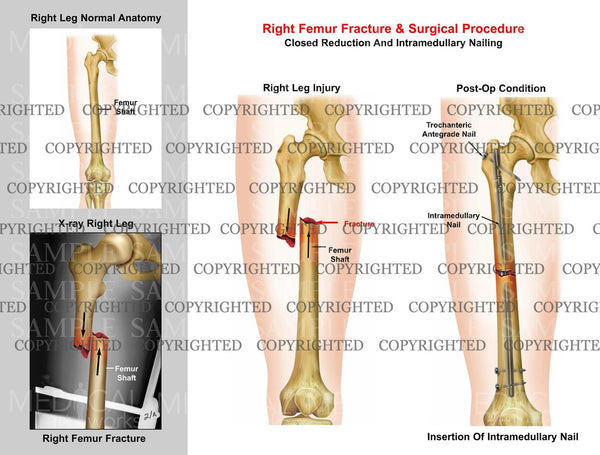 closed fracture of right femur icd 10