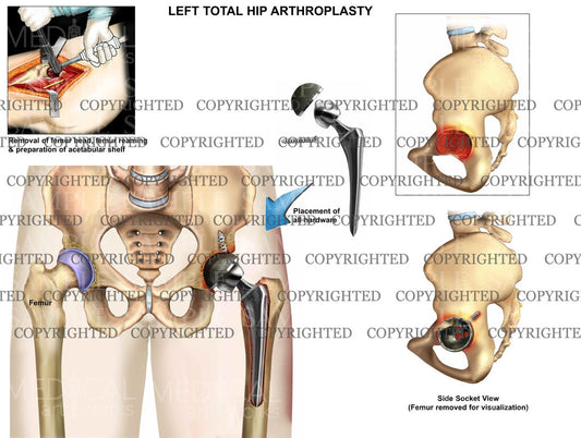 Total Hip Replacement of left hip
