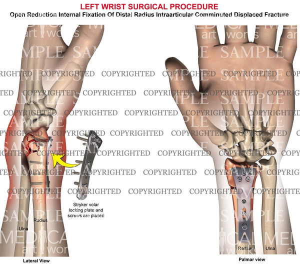 cpt code for orif radial head fracture