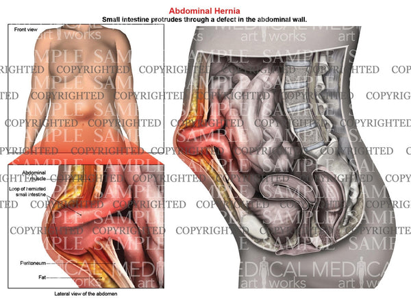 Abdominal Hernia Anatomy Of Female Medical Art Works